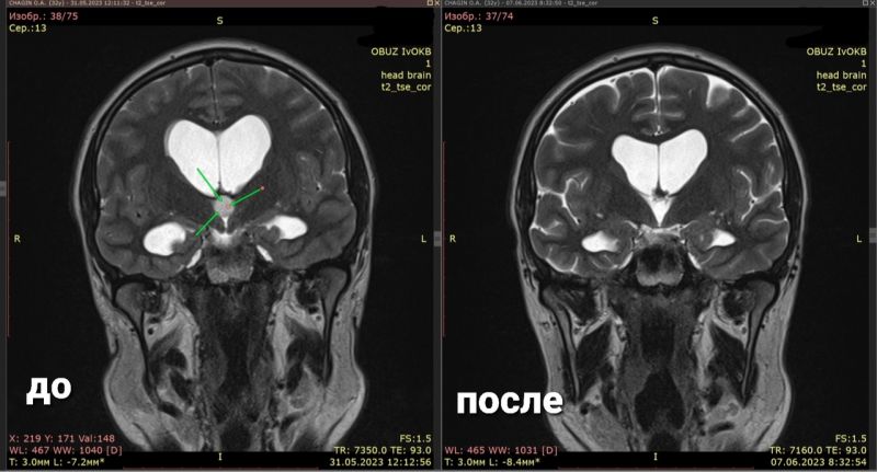 Ивановские врачи удалили пациенту кисту в мозге