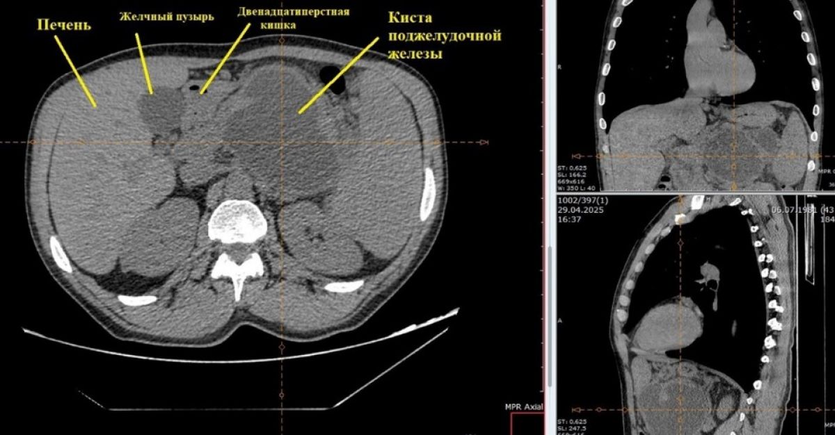 В орловской больнице прооперировали пациента с крупной псевдокистой поджелудочной железы