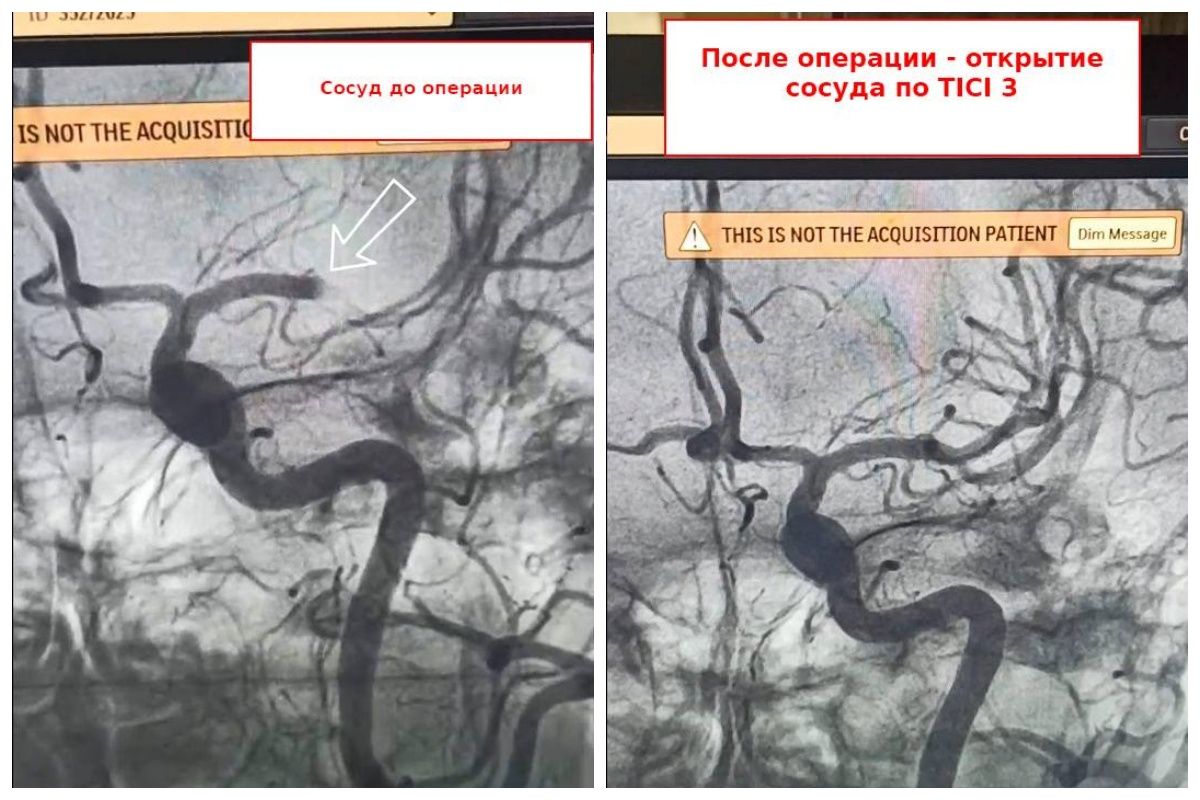 В Воронежской области пожилая женщина сразу же заговорила после удаления тромба из сосуда головного мозга