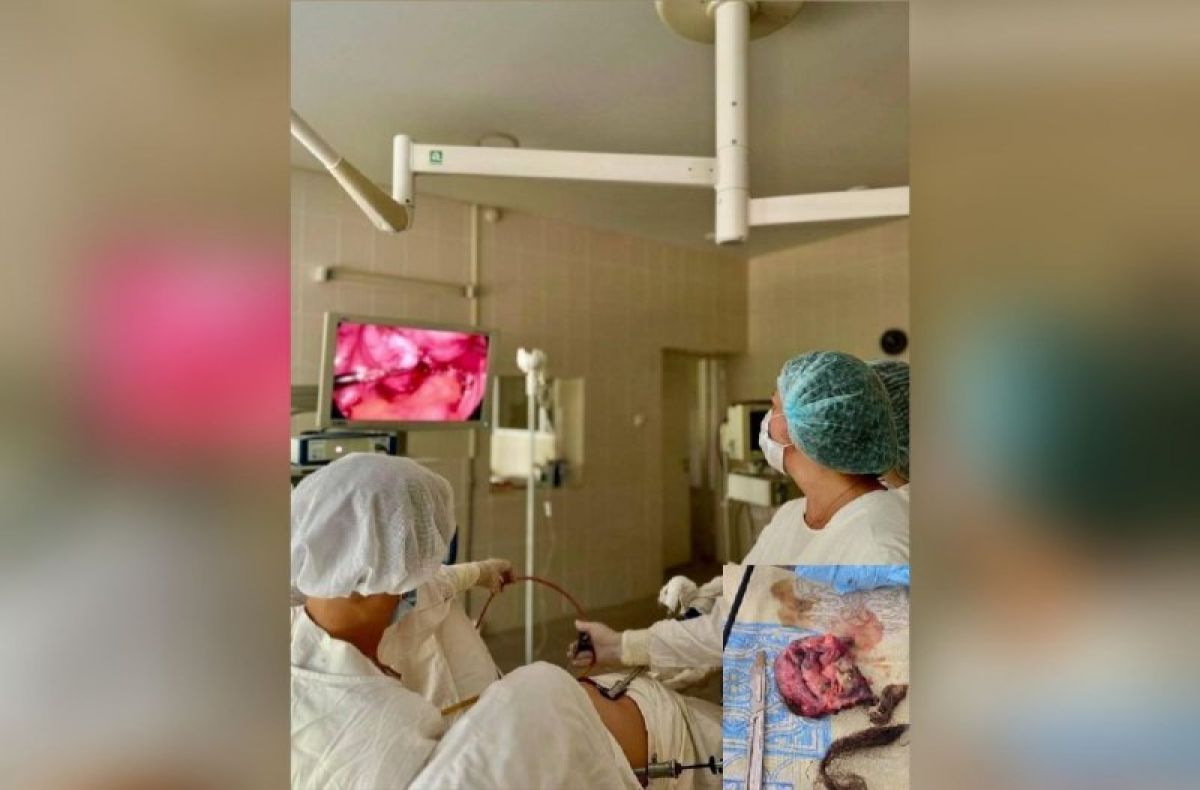 Воронежские врачи спасли пациентку от редкой опухоли яичника размером с грейпфрут