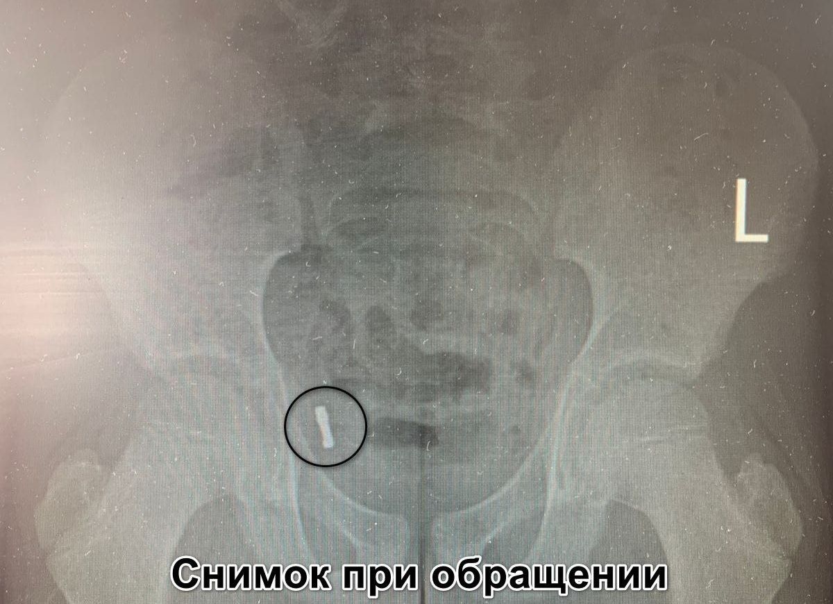 Проглоченный магнит достали из аппендикса малыша врачи областной детской клинической больницы №2