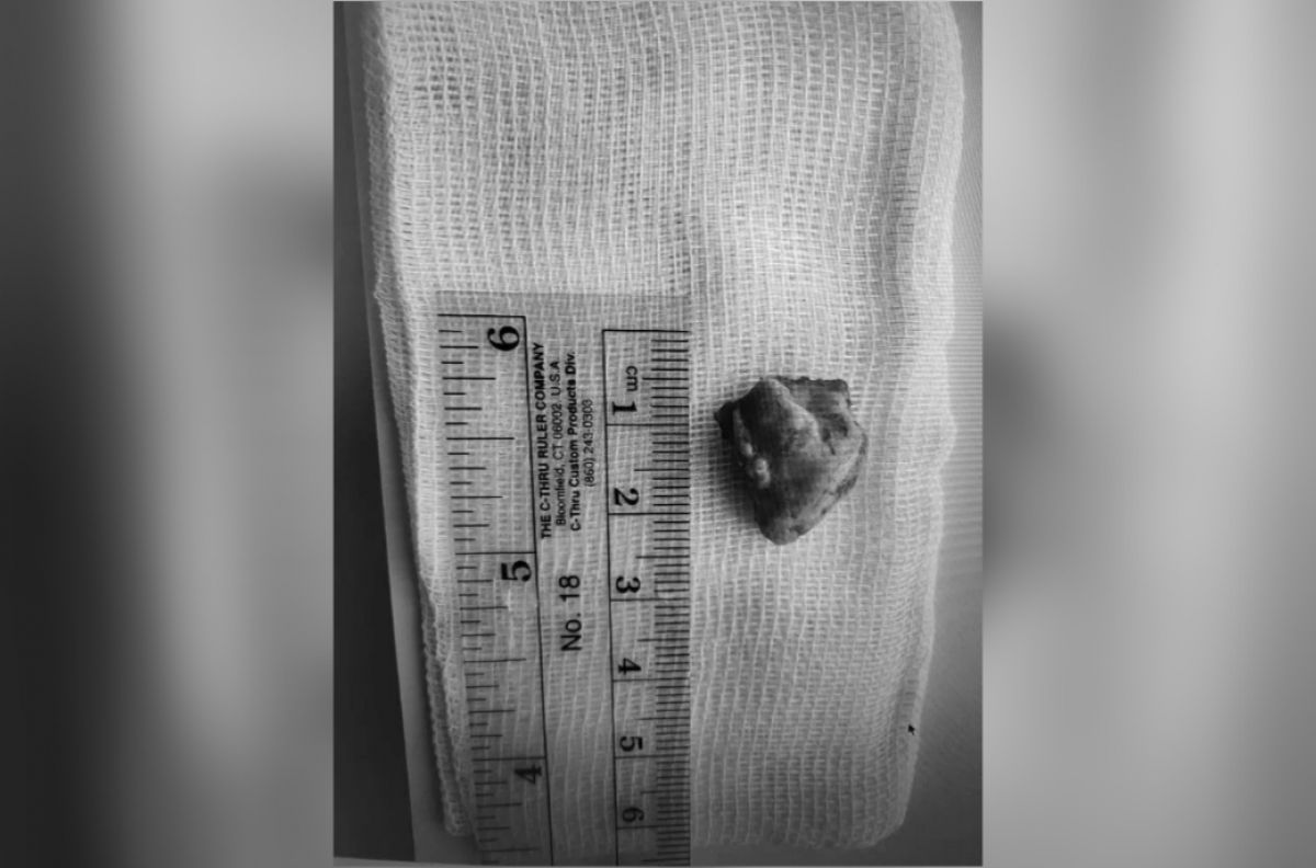 Воронежские хирурги удалили аномально расположенный зачаток зуба у подростка